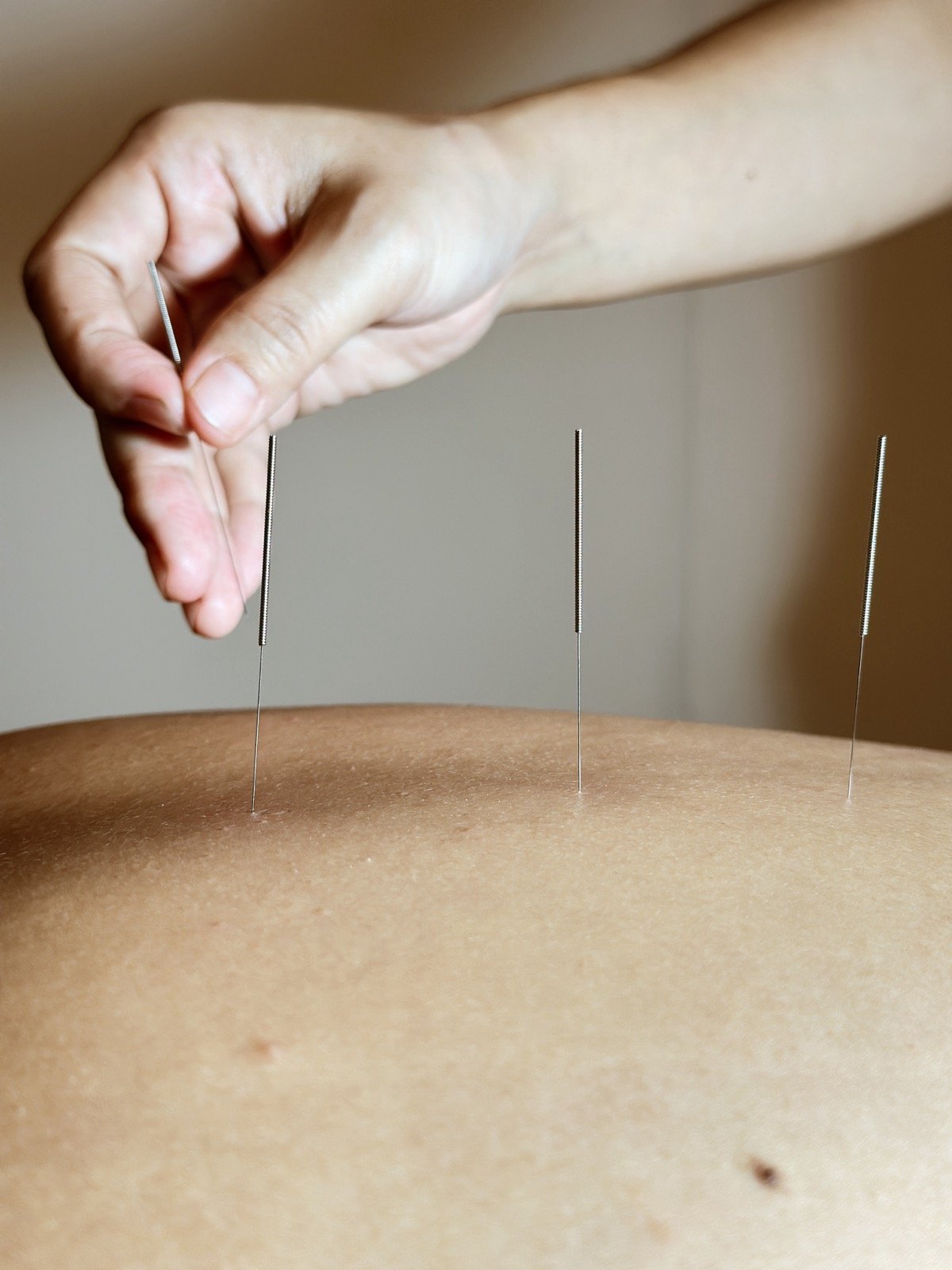 Acupuncture needle insertion close-up