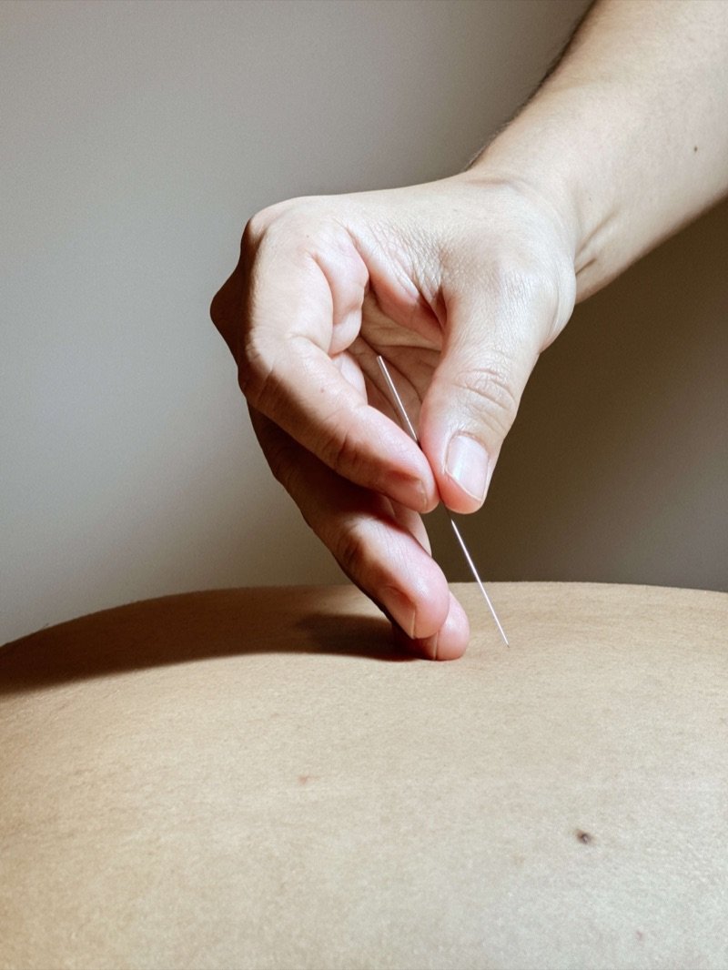 Full back cupping treatment