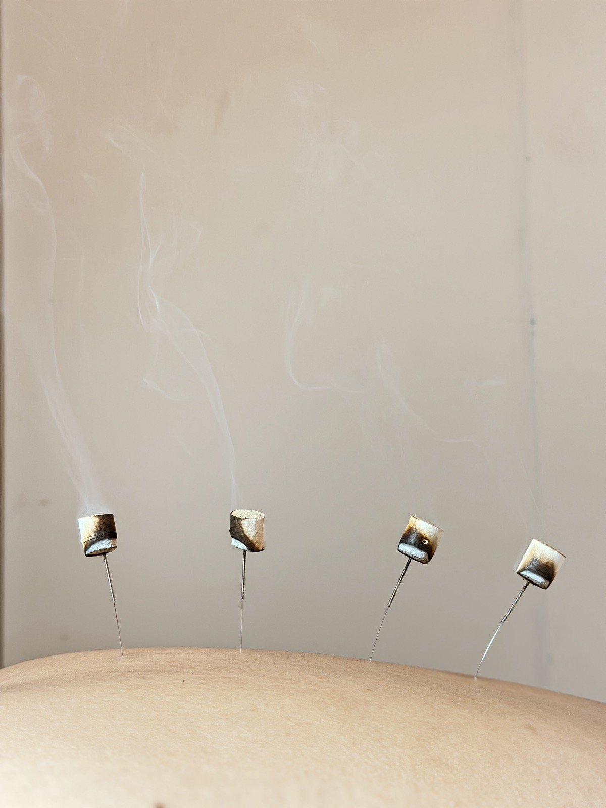 Moxibustion treatment at Piraluna